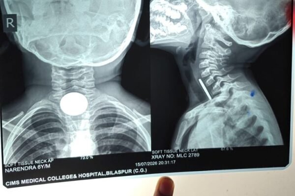 Surgery: 6 साल के बच्चे के गले में फंसा सिक्का, सिम्स डॉक्टरों ने बचाई जान
